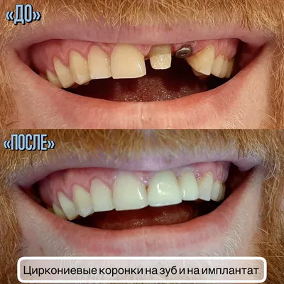 Циркониевая коронка